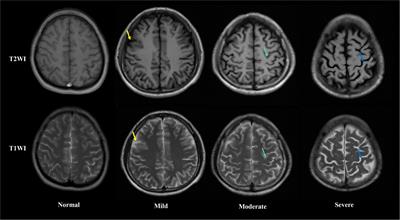 Frontiers | Association between abnormal plasma metabolism and brain